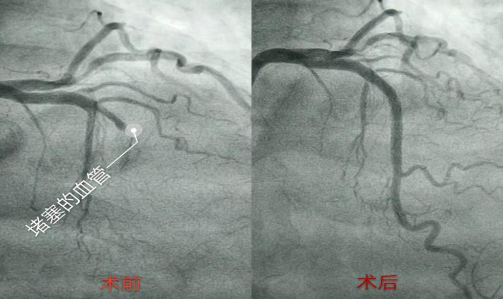 2,冠脉介入治疗技术:我科常规开展冠状动脉球囊扩张(ptca),冠状动脉